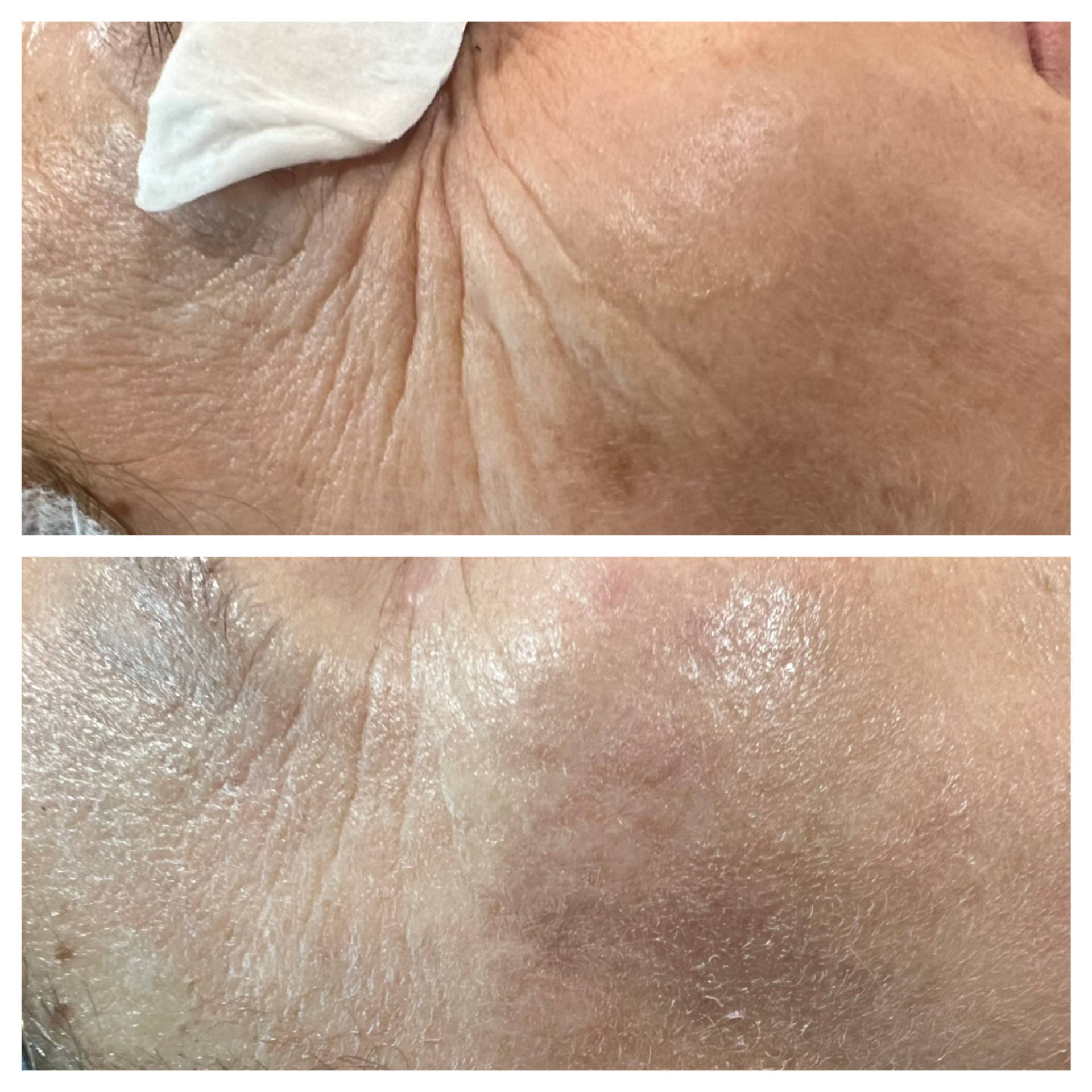 Resultado facial 1