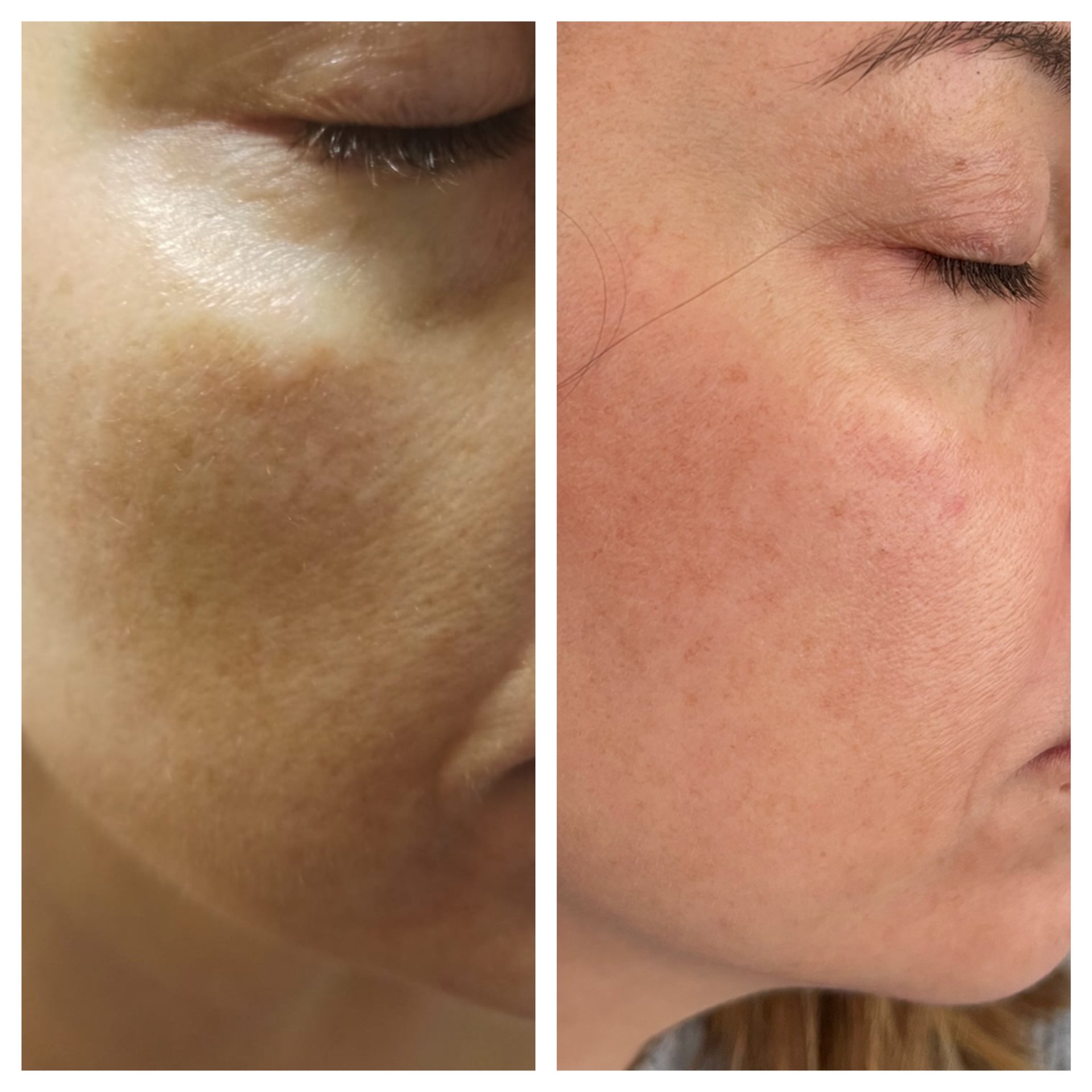 Resultado facial 2