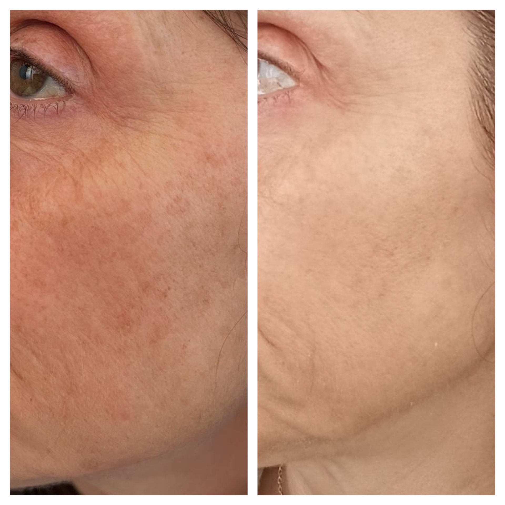 Resultado facial 4